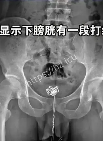男子往尿道塞数据线